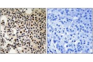 Immunohistochemistry analysis of paraffin-embedded human breast carcinoma, using PAK2 (Phospho-Ser197) Antibody. (PAK2 antibody  (pSer197))