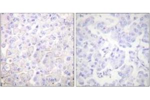 Immunohistochemistry analysis of paraffin-embedded human breast carcinoma tissue, using Cadherin-pan Antibody.