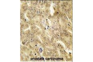 Formalin-fixed and paraffin-embedded human prostata carcinoma tissue reacted with HSP40 Antibody (ABIN1882092 and ABIN2846365) , which was peroxidase-conjugated to the secondary antibody, followed by DAB staining.