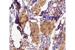 ABIN6266582 at 1/100 staining human breast carcinoma tissue sections by IHC-P. (Mammaglobin A antibody  (Internal Region))