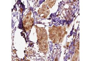 ABIN6266582 at 1/100 staining human breast carcinoma tissue sections by IHC-P.