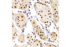 Immunohistochemistry of paraffin-embedded Human gastric injury using HNRNPA1 antibody at dilution of 1:100 (x40 lens).