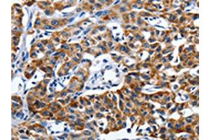 The image on the left is immunohistochemistry of paraffin-embedded Human lung cancer tissue using ABIN7191255(LAMA1 Antibody) at dilution 1/25, on the right is treated with synthetic peptide. (Laminin alpha 1 antibody)