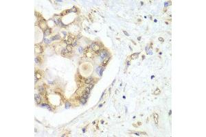 Immunohistochemistry of paraffin-embedded human liver cancer using VTI1B antibody at dilution of 1:100 (x40 lens).