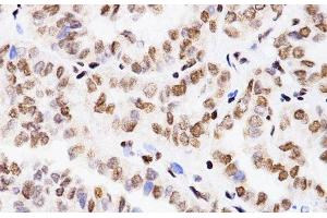 Immunohistochemistry of paraffin-embedded Human thyroid cancer using MonoMethyl-Histone H3-K4 Polyclonal Antibody at dilution of 1:200 (40x lens). (Histone 3 antibody  (meLys4))