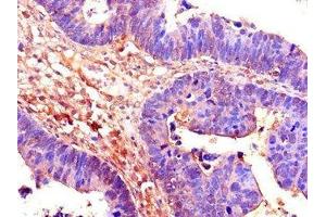 Immunohistochemistry of paraffin-embedded human ovarian cancer using ABIN7158853 at dilution of 1:100 (CDC25B antibody  (AA 1-195))