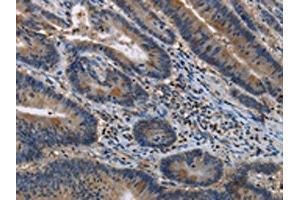 The image on the left is immunohistochemistry of paraffin-embedded Human colon cancer tissue using ABIN7191144(ITPR2 Antibody) at dilution 1/40, on the right is treated with synthetic peptide.