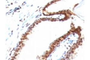 Formalin-fixed, paraffin-embedded human colon carcinoma stained with Double Stranded DNA antibody (DSD/958) (dsDNA antibody)