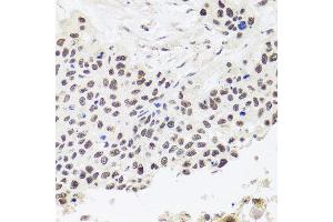 Immunohistochemistry of paraffin-embedded human lung cancer using RPP30 antibody at dilution of 1:100 (x40 lens). (RPP30 antibody)