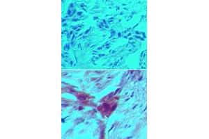 Immunohistochemical analysis of ARHGDIB monoclonal antibody, clone 97A1015  in formalin-fixed, paraffin-embedded human breast tumor tissue using an isotype control (top) and ARHGDIB monoclonal antibody, clone 97A1015  (bottom) at 5 ug/mL . (ARHGDIB antibody  (Cleavage Site))
