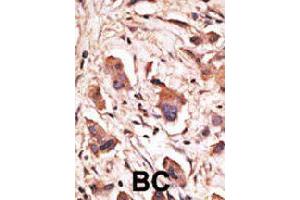 Formalin-fixed and paraffin-embedded human cancer tissue reacted with MAGED1 polyclonal antibody  , which was peroxidase-conjugated to the secondary antibody, followed by DAB staining. (MAGED1 antibody  (Internal Region))