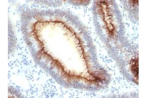 Formalin-fixed, paraffin-embedded human Colon Carcinoma stained with CEA Mouse Recombinant Monoclonal Antibody (rC66/1009). (Recombinant CEACAM5 antibody)