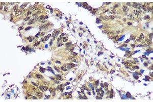 Immunohistochemistry of paraffin-embedded Human colon carcinoma using UBA1 Polyclonal Antibody at dilution of 1:100 (40x lens).