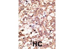 Formalin-fixed and paraffin-embedded human hepatocellular carcinoma tissue reacted with KREMEN1 polyclonal antibody , which was peroxidase-conjugated to the secondary antibody, followed by AEC staining. (KREMEN1 antibody  (N-Term))