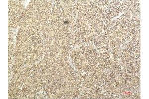 Immunohistochemical analysis of paraffin-embedded Human Kidney Carcinoma Tissue using SGK1 Mouse mAb diluted at 1:200. (SGK1 antibody  (AA 350-430))