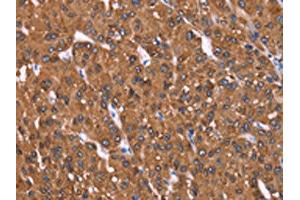 The image on the left is immunohistochemistry of paraffin-embedded Human liver cancer tissue using ABIN7191000(HRASLS2 Antibody) at dilution 1/40, on the right is treated with synthetic peptide. (HRASLS2 antibody)