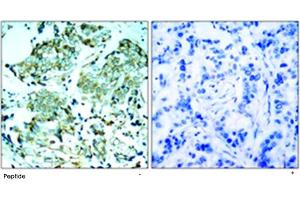 Immunohistochemical analysis of paraffin-embedded human breast carcinoma tissue using EGFR polyclonal antibody . (EGFR antibody)