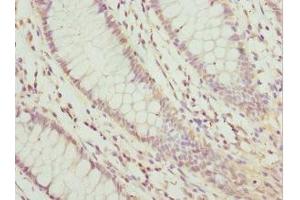Immunohistochemistry of paraffin-embedded human colon cancer using ABIN7157970 at dilution of 1: 100