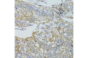 Immunohistochemistry of paraffin-embedded human gastric cancer using CHMP4B antibody. (CHMP4B antibody)