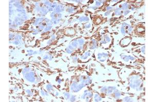 Formalin-fixed, paraffin-embedded human Colon Carcinoma stained with Vimentin Mouse Monoclonal Antibody (VIM/3736). (Vimentin antibody  (AA 2-466))