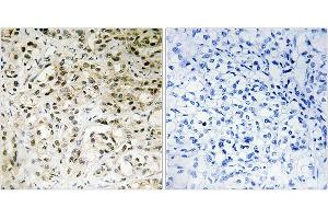 Immunohistochemistry analysis of paraffin-embedded human liver carcinoma tissue using TAF5 antibody. (TAF5 antibody)