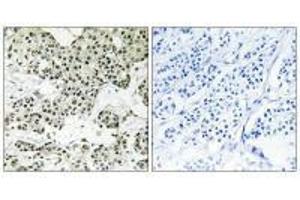 Immunohistochemistry analysis of paraffin-embedded human breast carcinoma tissue using THOC5 antibody.