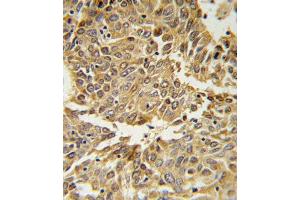 HIF1A Antibody (N-term) (ABIN650972 and ABIN2840017) IHC analysis in formalin fixed and paraffin embedded lung carcinoma followed by peroxidase conjugation of the secondary antibody and DAB staining. (HIF1A antibody  (N-Term))