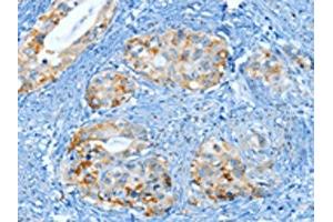 The image on the left is immunohistochemistry of paraffin-embedded Human cervical cancer tissue using ABIN7130299(MUC15 Antibody) at dilution 1/25, on the right is treated with fusion protein. (MUC15 antibody)