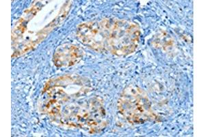 The image on the left is immunohistochemistry of paraffin-embedded Human cervical cancer tissue using ABIN7130299(MUC15 Antibody) at dilution 1/25, on the right is treated with fusion protein. (MUC15 antibody)