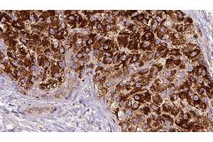 ABIN6272680 at 1/100 staining Human liver cancer tissue by IHC-P. (CCR3 antibody  (C-Term))