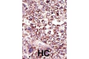 Formalin-fixed and paraffin-embedded human cancer tissue reacted with the primary antibody, which was peroxidase-conjugated to the secondary antibody, followed by DAB staining. (Ribophorin II antibody  (N-Term))