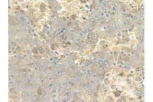 ABIN6262821 and ABIN6272334 at 1/100 staining human melanoma by IHC-P.