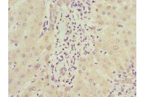 Immunohistochemistry of paraffin-embedded human liver cancer using ABIN7156542 at dilution of 1:100 (ICAM4 antibody  (AA 20-140))