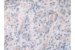 IHC-P analysis of Human Prostate Gland Cancer Tissue, with DAB staining. (SIRT4 antibody  (AA 28-314))