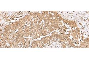 Immunohistochemistry of paraffin-embedded Human esophagus cancer tissue using RCHY1 Polyclonal Antibody at dilution of 1:50(x200) (RCHY1 antibody)