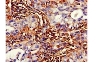 Immunohistochemistry of paraffin-embedded human lung cancer using ABIN7175344 at dilution of 1:100