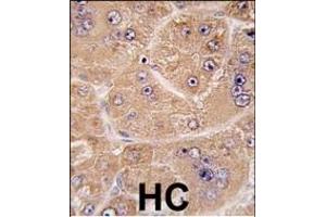 Formalin-fixed and paraffin-embedded human hepatocarcinoma tissue reacted with FUCA2 antibody (N-term) (ABIN391985 and ABIN2841774) , which was peroxidase-conjugated to the secondary antibody, followed by DAB staining. (FUCA2 antibody  (N-Term))