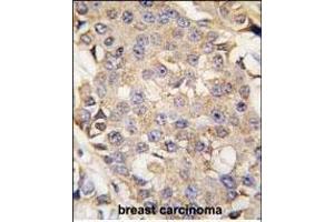 Formalin-fixed and paraffin-embedded human breast carcinoma tissue reacted with ERK1 antibody (N-term) (ABIN391719 and ABIN2841609) , which was peroxidase-conjugated to the secondary antibody, followed by DAB staining. (ERK1 antibody  (N-Term))