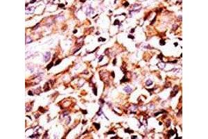 IHC analysis of FFPE human breast carcinoma tissue stained with the phospho-Bad antibody. (BAD antibody  (pSer99))