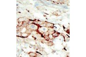 Formalin-fixed and paraffin-embedded human cancer tissue reacted with the primary antibody, which was peroxidase-conjugated to the secondary antibody, followed by AEC staining. (FGFR2 antibody  (N-Term))