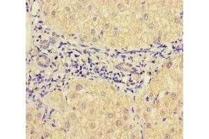 Immunohistochemistry of paraffin-embedded human liver cancer using ABIN7175471 at dilution of 1:100 (VAMP1 antibody  (AA 1-96))