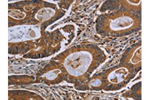 The image on the left is immunohistochemistry of paraffin-embedded Human colon cancer tissue using ABIN7190808(GJB4 Antibody) at dilution 1/40, on the right is treated with synthetic peptide. (GJB4 antibody)