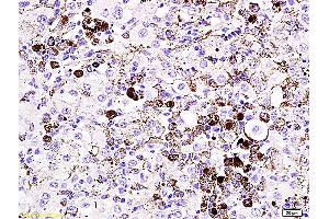 Formalin-fixed and paraffin embedded mouse melanoma labeled with Anti- MITF Polyclonal Antibody, Unconjugated (ABIN676373) at 1:200 followed by conjugation to the secondary antibody and DAB staining (MITF antibody  (AA 351-450))