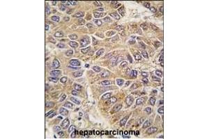 Formalin-fixed and paraffin-embedded human hepatocarcinoma tissue reacted with UGP2 antibody (C-term) (ABIN6243325 and ABIN6578920) , which was peroxidase-conjugated to the secondary antibody, followed by DAB staining. (UGP2 antibody  (C-Term))