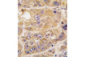 Formalin-fixed and paraffin-embedded human hepatocarcinoma tissue reacted with LDLRAP1 antibody , which was peroxidase-conjugated to the secondary antibody, followed by DAB staining. (LDLRAP1 antibody  (C-Term))
