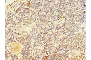Immunohistochemistry of paraffin-embedded human lung cancer using ABIN7162495 at dilution of 1:100 (Paired Box 3 antibody  (AA 90-184))