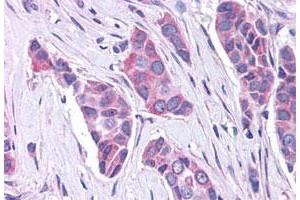 Immunohistochemistry (Formalin/PFA-fixed paraffin-embedded sections) of human breast cancer tissue with GPER polyclonal antibody . (GPER antibody  (C-Term))