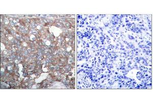 Immunohistochemical analysis of paraffin-embedded human breast carcinoma tissue, using Cortactin (Ab-421) antibody (E021263). (Cortactin antibody)