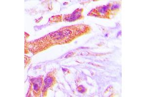 Immunohistochemical analysis of PSMD6 staining in human lung cancer formalin fixed paraffin embedded tissue section. (PSMD6 antibody  (Center))