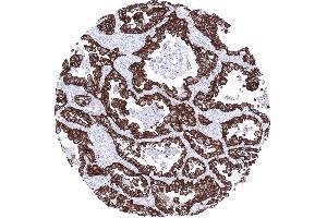 Strong EPCAM staining in an adenocarcinoma of the lung (Recombinant EpCAM antibody  (Extracellular Domain))